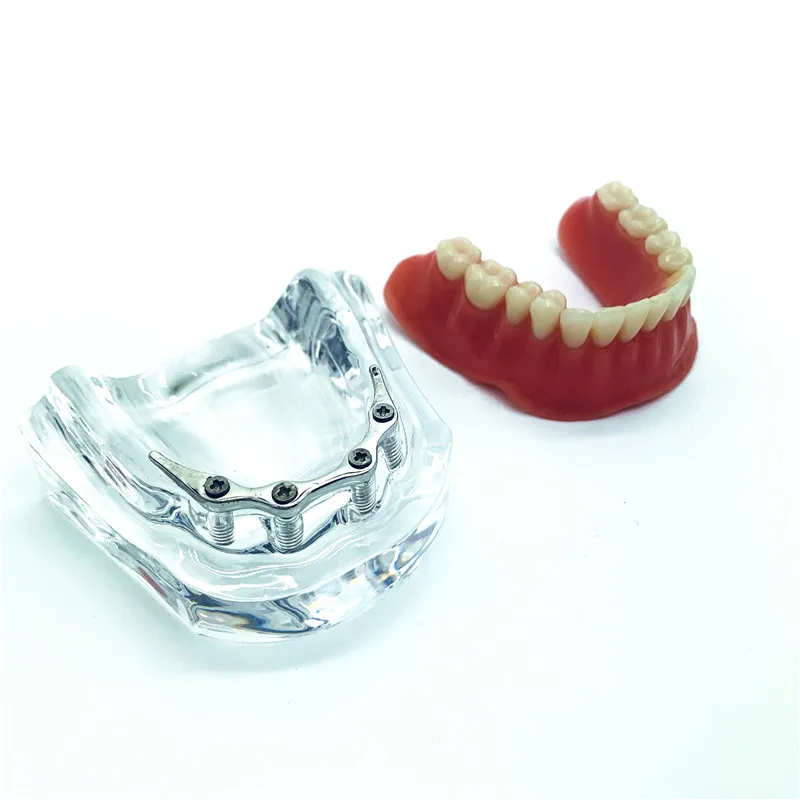 Модель зубного импланта mandibular модель для ремонта обучения