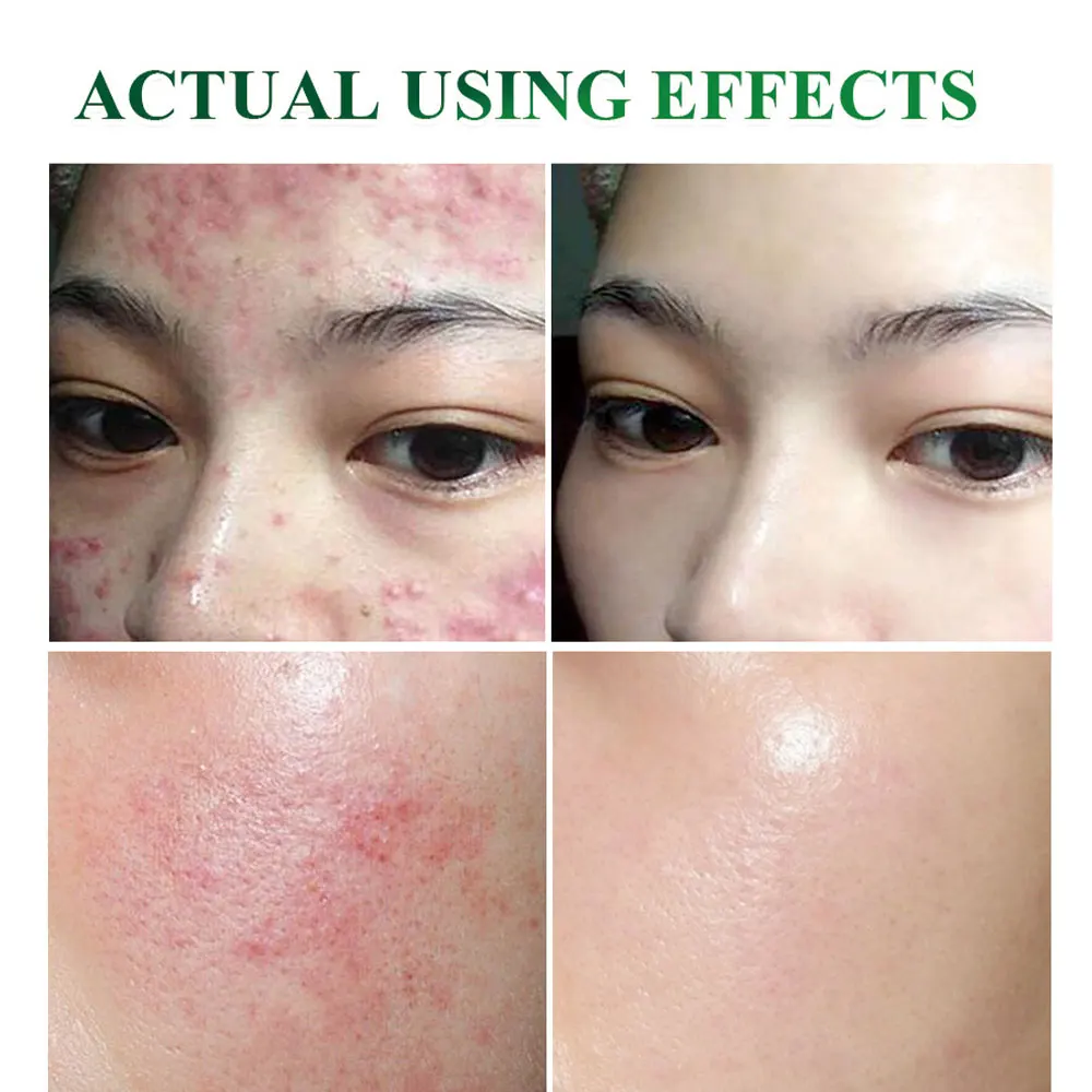 AcnePimple Patch Acne Treatment Serum Acne Cream Pimple Remover Tool Skin Care Face Cream Facial Serum Essence Face Mask