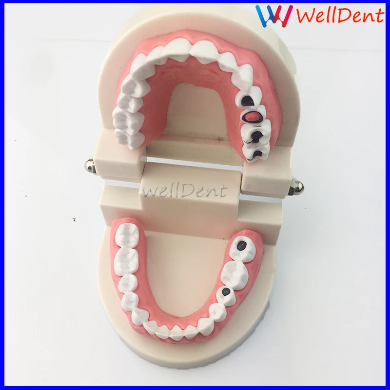 1x-EASYINSMILE-Dental-Caries-Tooth-Study-Model-Typodont