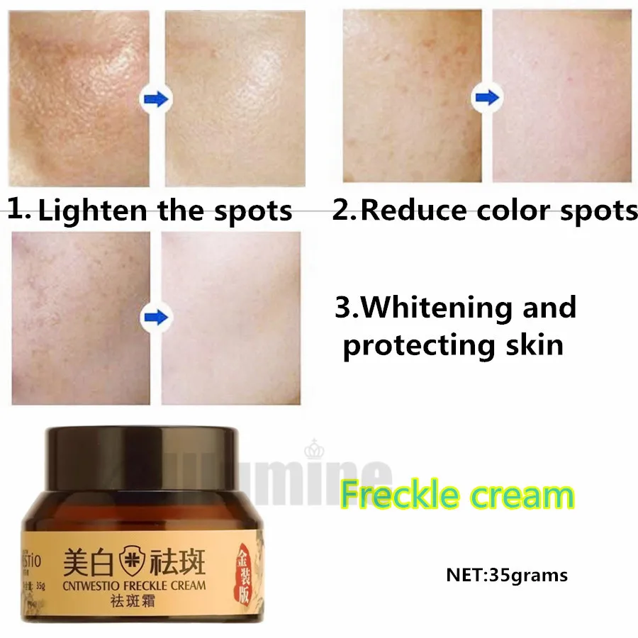 Whiten Freckle Removing Chloasma Removing Freckles Spot Sunburn