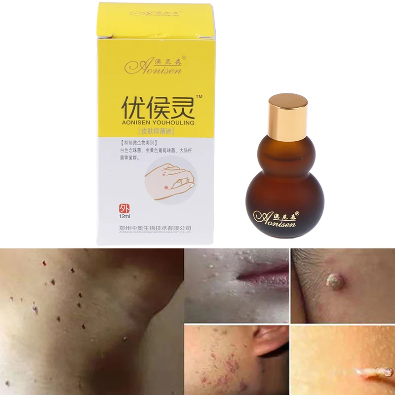 

12ml Mole & Skin Tag Cream Dark Spot Removal Wart Tag Freckle Removal Oil Mole Skin Tag Removal Solution Painless Cream