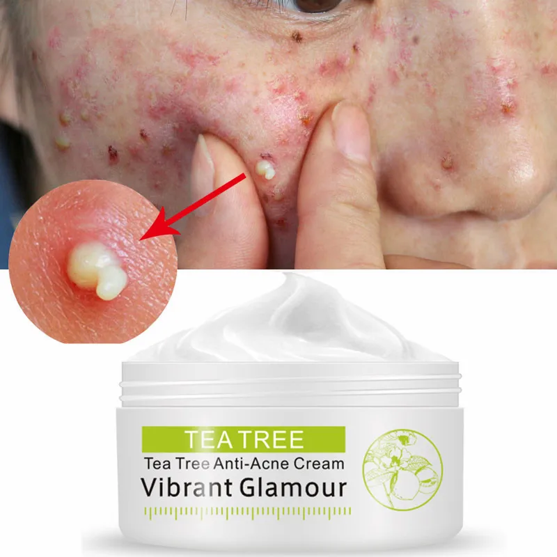 

30g Acne Treatment Face Cream Anti Acne Scar Removal Pimple Blackhead Moisturizing Whiten Oil-control Shrink Pores Skin Care