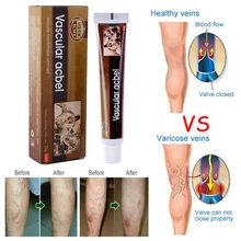 Уход за кожей ног, массажный крем для варикозного расширения, облегчение флебита, ангиит, розжиг, мазь для кровеносных сосудов, Новинка