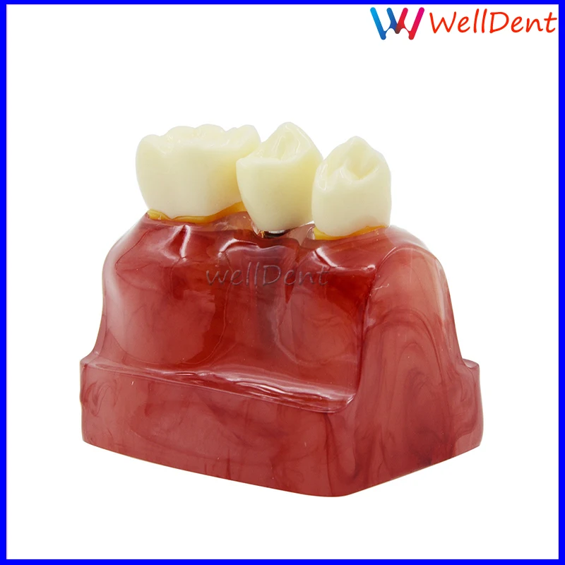 1-Macro-Implant-Model-Crown-Bridge-Demostratation-Teeth-_57 (1)