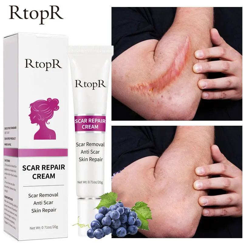 Acne Scar Removal Cream Pimples Stretch Marks Face Gel Remove Surgical
