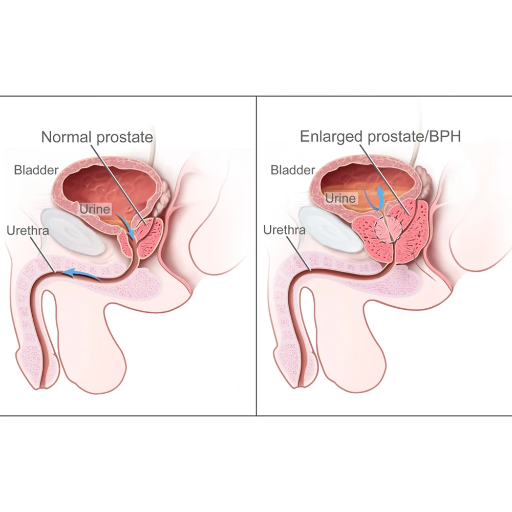 prostate hyperplasia csomó)