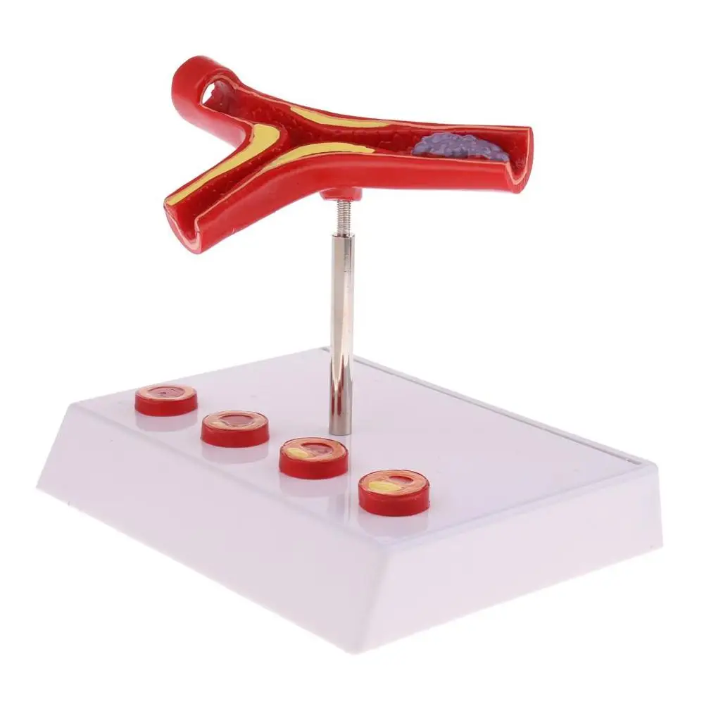 

50 Times Enlarged Human Vessel Atherosclerosis Vascular Model Lab Supplies