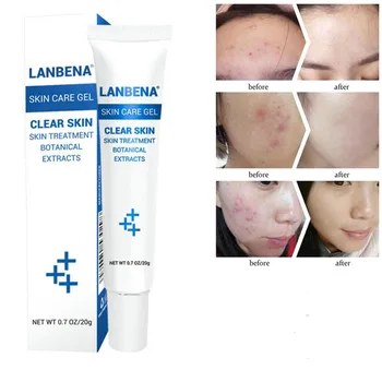 

20G Anti Acne Moisturizing Gel cream Oil Control Shrink Pores oily skin Acne Spots Face skin care repairing Shrink Pores
