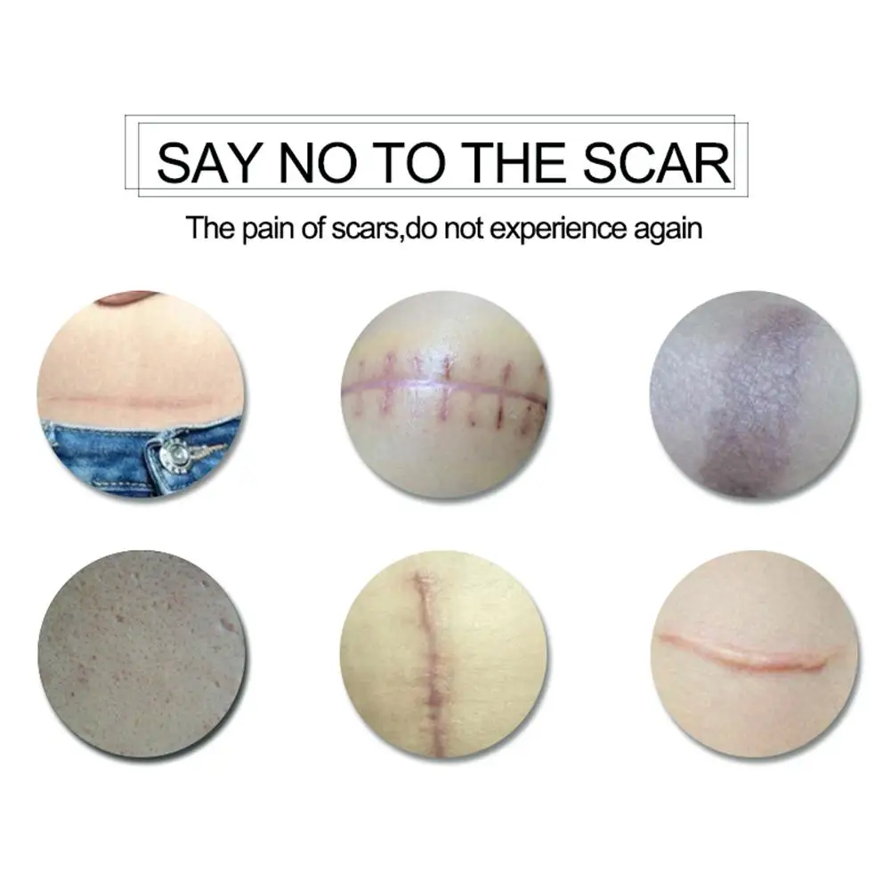 Repair Scar Cream Removal Acne Scars Gel Stretch Marks Surgical Scar Burn For Body Pigmentation Corrector 1 Repair Scar Cream Removal Acne Scars Gel Stretch Marks Surgical Scar Burn For Body Pigmentation Corrector 3
