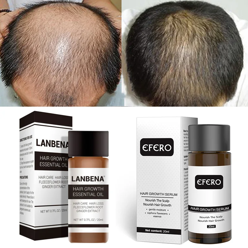 Эссенция для быстрого роста волос Предотвращение выпадения волос эссенция уход утолщение роста волос сыворотка лечебные продукты забота о здоровье 20 мл
