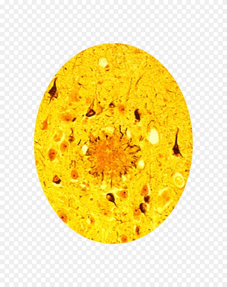 阿尔茨海默病老年斑块神经原纤维缠结性痴呆老年痴呆症关联-小鼠脑