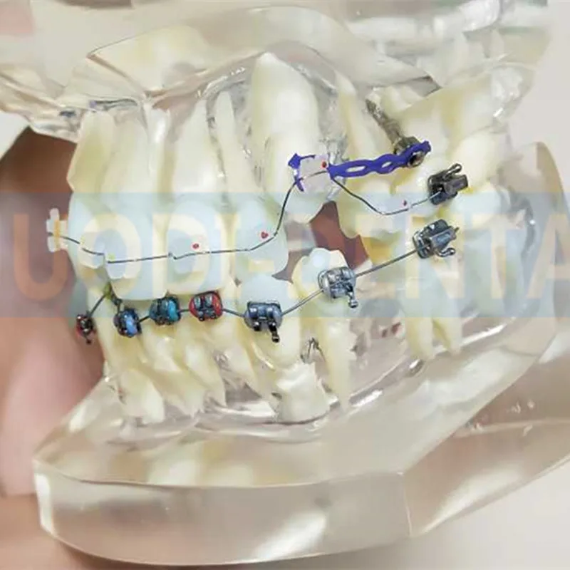 Прозрачная Стоматологическая Ортодонтическая модель Mallocclusion с кронштейнами