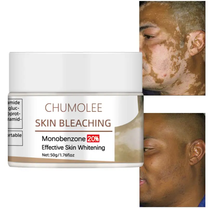 Chumolee Monobenzone Skin Bleaching Whitening Face Cream White Spot Vitiligo Treament Fade Dark Spots Age Spot Skin Care Day Creams Moisturizers Aliexpress Chumolee Monobenzone Skin Bleaching Whitening Face Cream White Spot Vitiligo Treament Fade Dark Spots Age Spot Skin Care Day Creams Moisturizers Aliexpress