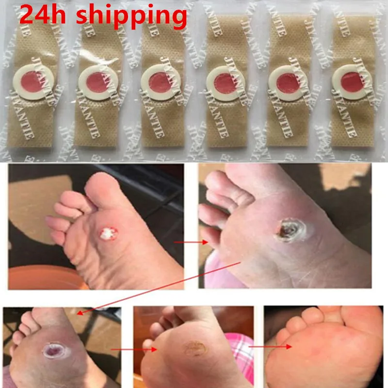 30 pièces autocollant de soins des pieds Patch médical tampons d'élimination du maïs verrues épine patchs curatifs callosités supprimer callosité Detox |
