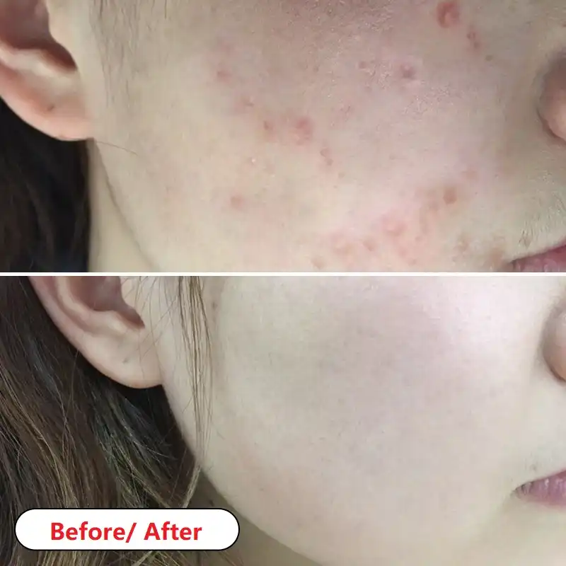 acne cream with tea tree oil