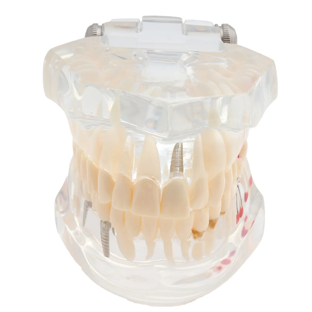 Dental dos Dentes Ortodôntico dos Dentes com Suportes Implante e Modelo da Restauração Fio da Ligadura Modelo Padrão Tubos Bucais & 4 dos dentes com suportes & tubos bucais