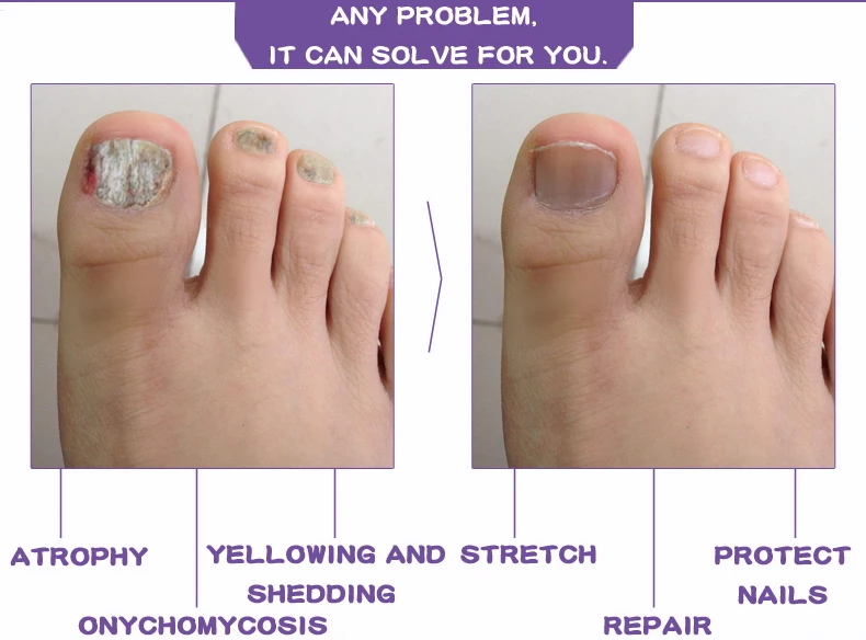 Fungal Nail Treatment