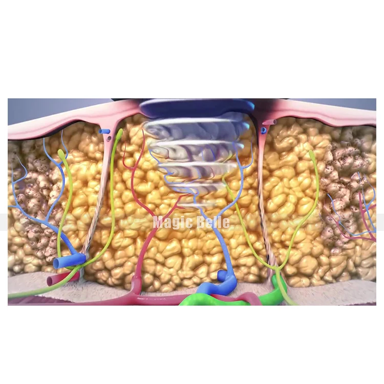 Специально для Вас! Ультразвуковая 5в1 машина для растворения жира с кавитацией 40 кГц