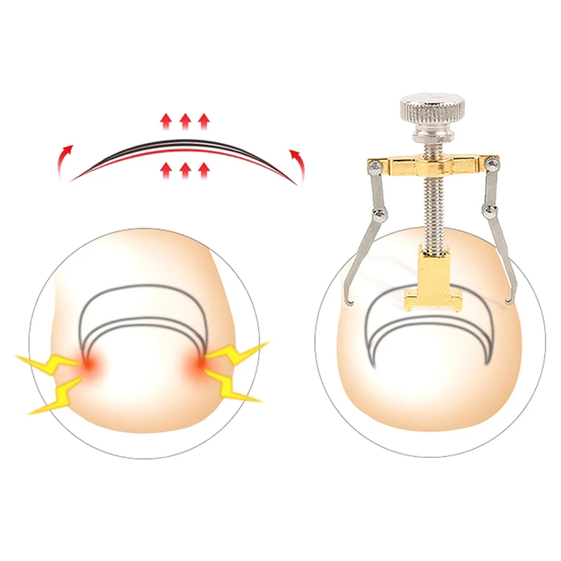 Ingrown Toenails Correction Pedicure Foot Toe Nail Care Tools File Elastic Patch Straightening Clip Brace Corrector