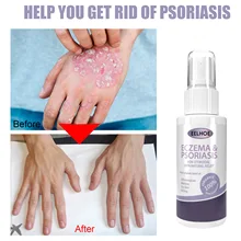 

Herbal Antibacterial Spray Anti-Fungal Itch Remove Psoriasis Dermatitis Eczema Serum Treatment Rash Urticaria Desquamation Care