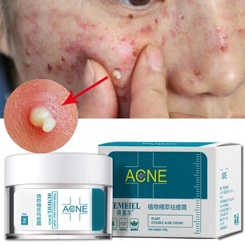 

Acne Treatment Face Cream Plant Essence Anti-Acne Cream Scar Removal Pimple Blackhead Moisturizing Whiten Shrink Pores Skin Care