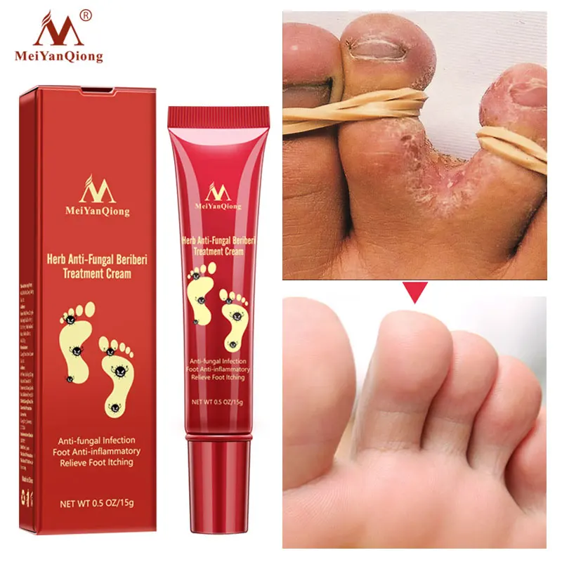 

Herbal Foot Cream Anti Fungal Infection Paronychia Toe Anti-inflammatory Remove Fungus Cream Gel Repair Dry Crack Feet Care 15g
