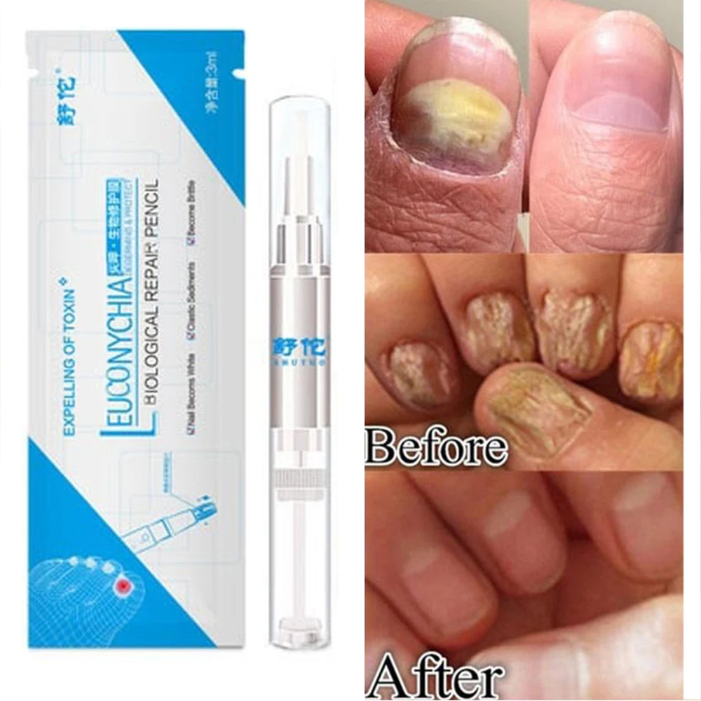 

Anti Fungal Treatment Nail Pen Onychomycosis Paronychia Infection Herbal Toe Finger Nails Health Treatment Beauty Accessories