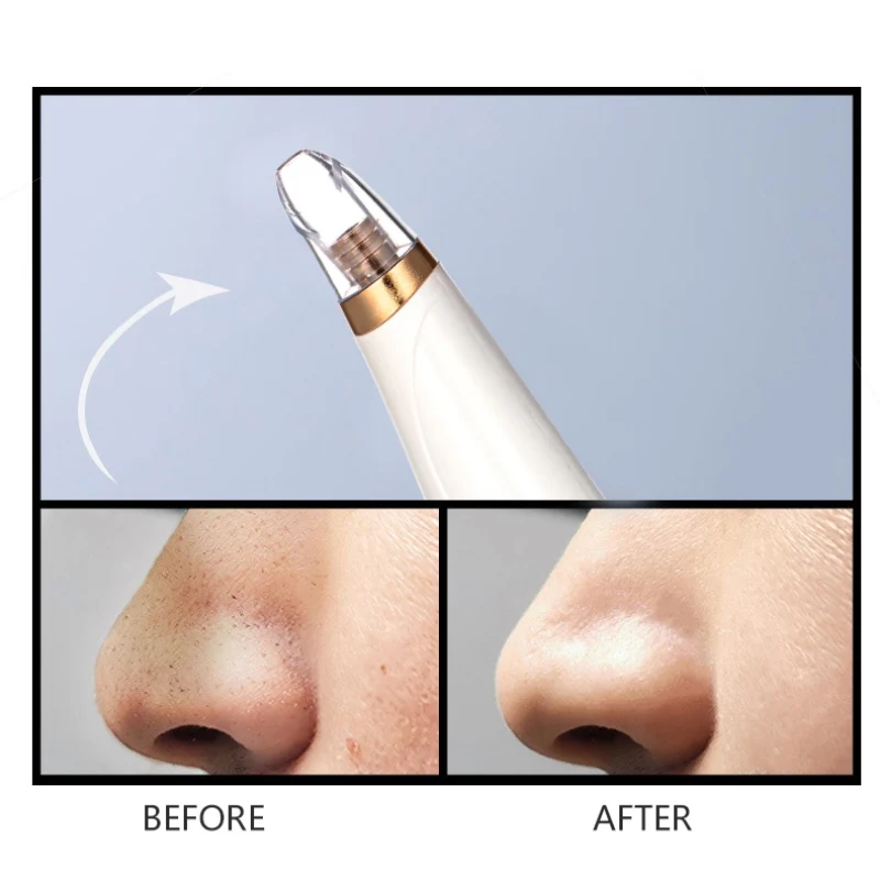 Очищение пор устройство Blackhead всасывающее масло для головы-контроль укрепляющий инструмент для ухода за кожей