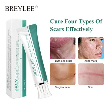 

BREYLEE Scar Removal Cream sivilce kremi snow white pimple cicatrices eliminar Gel acne treatment dark spot remover for face