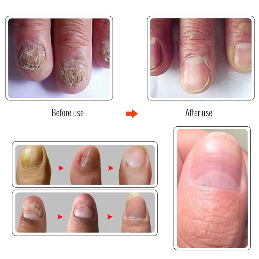 Красота Onychomycosis жидкость для восстановления ногтей 10 мл эффективный набор