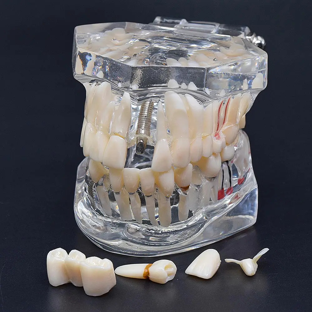 1 Uds implante Dental enfermedad dientes modelo restauración puente Diente de dentista para la ciencia médica enfermedad Dental estudio pedagógico