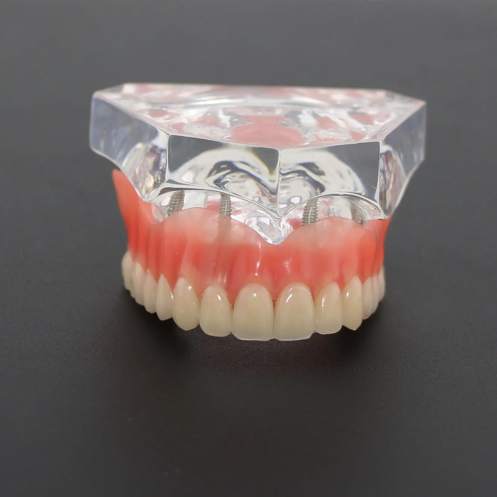 Стоматологическая модель верхних зубов Overdenture Superior 4 имплантата 6001