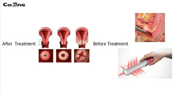 Гинекологический Вибрационный дисменорея вагинальный лазер, Утягивающее устройство для здоровья женщин