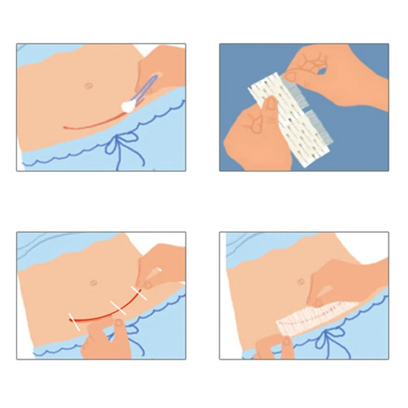 10 упаковок/партия, медицинская хирургическая клейкая лента, нет необходимости в шитье, закрывание кожи, 12*100 мм, повязка на рану, закрывающие полосы