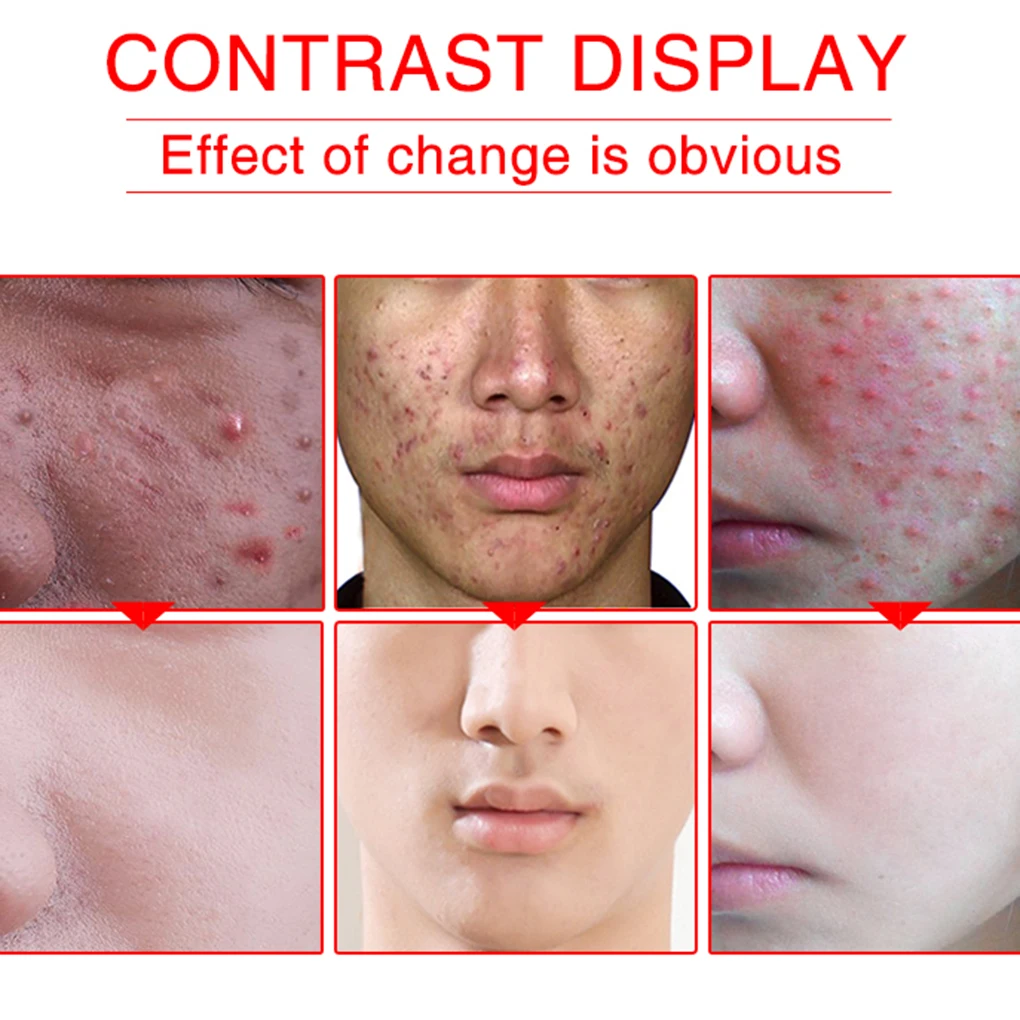 Oedo Oligopeptide плаценты жидкость лечение от прыщей, Отбеливание Сущность Питательная, для лица Уход за кожей с сывороткой