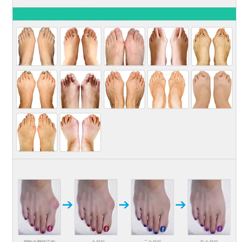 OPHAX 2 шт./1 пара Силиконовый гель Bunion шина сепаратор для большого пальца ноги