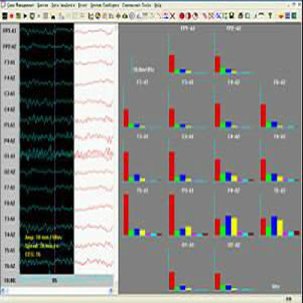 Medical Equipment CONTEC CMS4100 16 Channel 24H Dynamic EEG System eeg holter Monito
