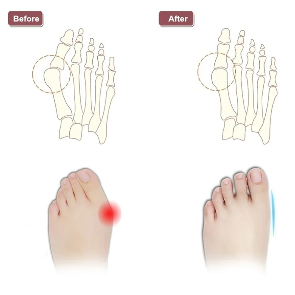 Newest 2PCS Multifunctional Hallux Valgus Foot Toes Separator Gel Toe Bunion Corrector Shield Orthopedic Braces Newest 2PCS Multifunctional Hallux Valgus Foot Toes Separator Gel Toe Bunion Corrector Shield Orthopedic Braces