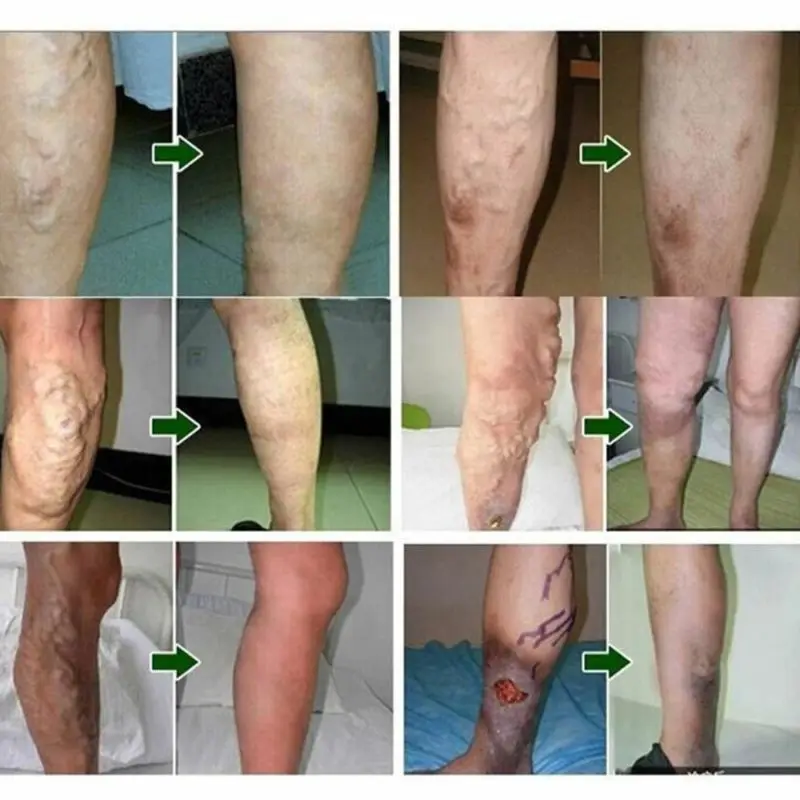 Крем для лечения варикозного расширения вен, мазь, васкулит, флебит, паук, боль в венах, варикозность, ангиит, средство для удаления травяного крема