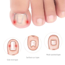 

1Box Front nail hook/rubber band Nail Art Ingrown Toe Nail Correction Toenail Nail Ingrown Clip Orthosis Paronychia Pedicure