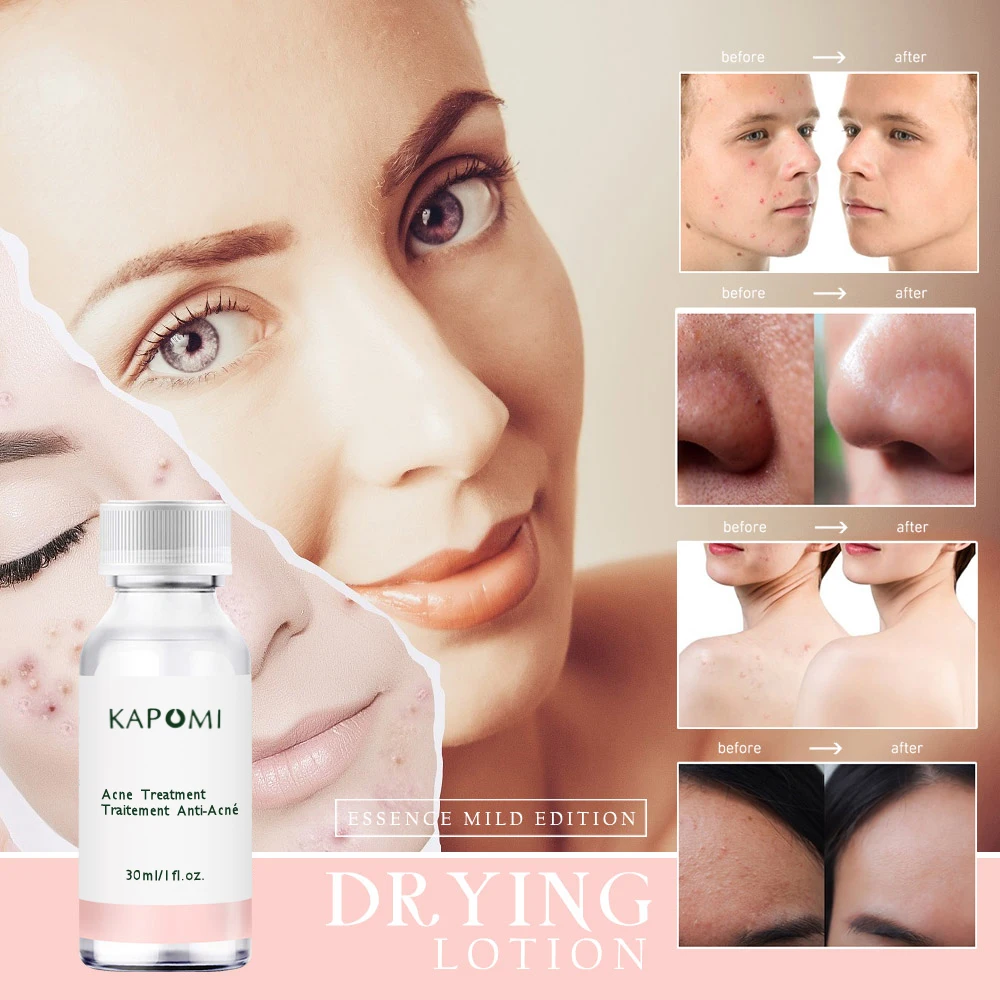 

Essence Acne Treatment Essence Facial Anti-Acne Acne Removal Skin Care Acne Removal Repair Serum