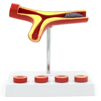 

10X Enlarge Human Arterial Arteriosclerosis Atherosclerosis Coronary Cross Section