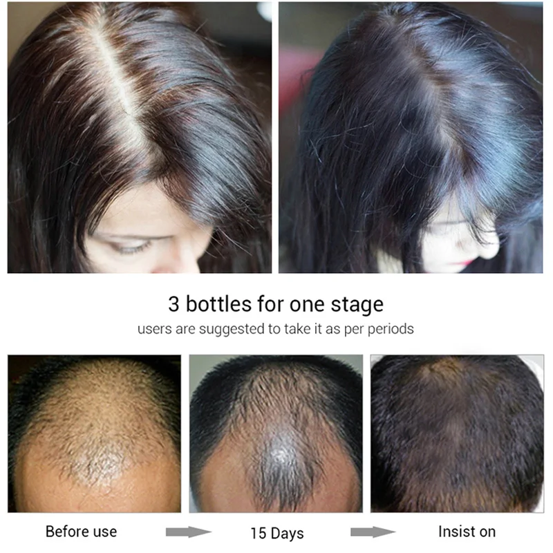 PUTIMI быстро мощная сывороточная эссенция для роста волос, питательные средства для ухода за волосами, против выпадения волос, для женщин и мужчин, для предотвращения облысения, 20 мл