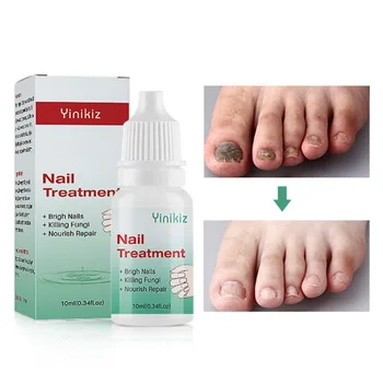 

10ml Nail Fungal Treatment Anti Fungus Onychomycosis Removal Toenail Care Nails Repair Liquid