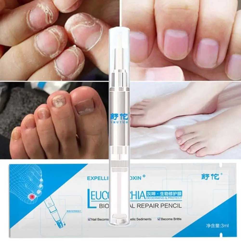Противогрибковое Лечение ногтей ручка онихомикоз Paronychia инфекция травяные пальцы ног ногти Здоровье Лечение грибка ногтей массаж