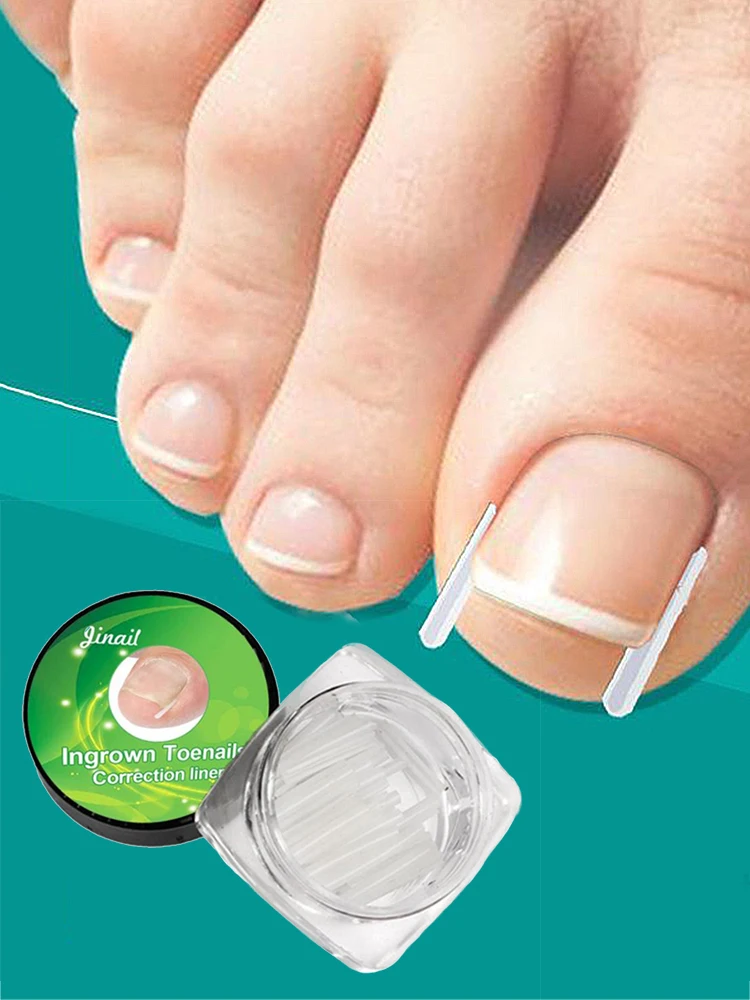 Pedicure 10pcs/set Ingrown Nail Pad Ortho Nail Filling Nail Groove Pad