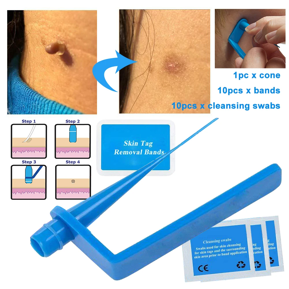Micro Band Non Toxic Face Care Mole Wart Tool For Small To Medium Blue Skin Tag Removal Kit With Cleansing Swabs Home Use Adult Facial Care Tool Aliexpress