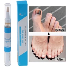 1 шт., ручка для лечения грибка для ногтей, китайский травяной антигрибковый Уход за ногтями