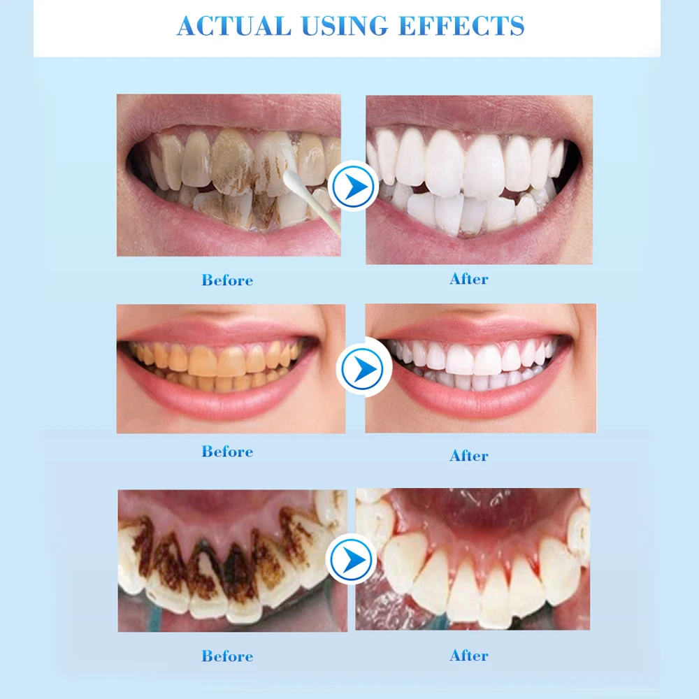 1 шт., отбеливающая Сыворотка для зубов, гель, гигиена полости рта, эффективное удаление пятен, зубной налет, чистящая эссенция, уход за зубами, зубная паста