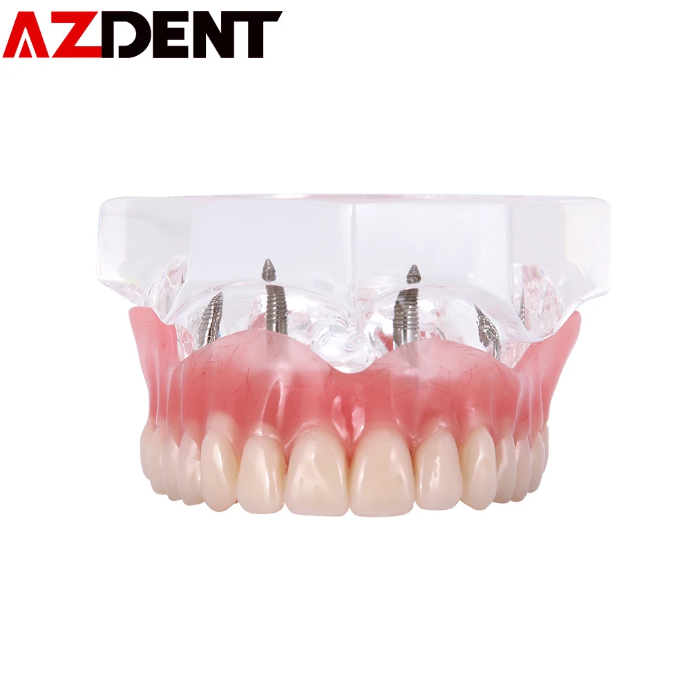 Dental Overdenture Teeth Model Removable Interior Mandibular Lower Teeth Model Mandibular with Implant for Tooth Teaching Study